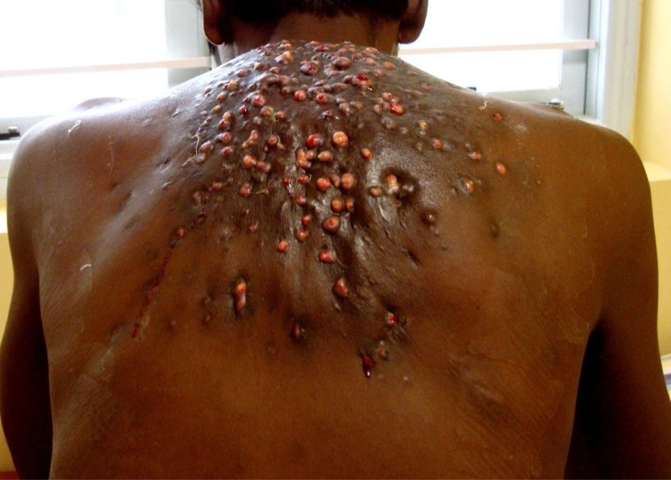 Botflies-maggot-monster-living-inside-the-body-945x676.jpg