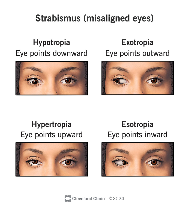 strabismus-eye-misalignment.jpg